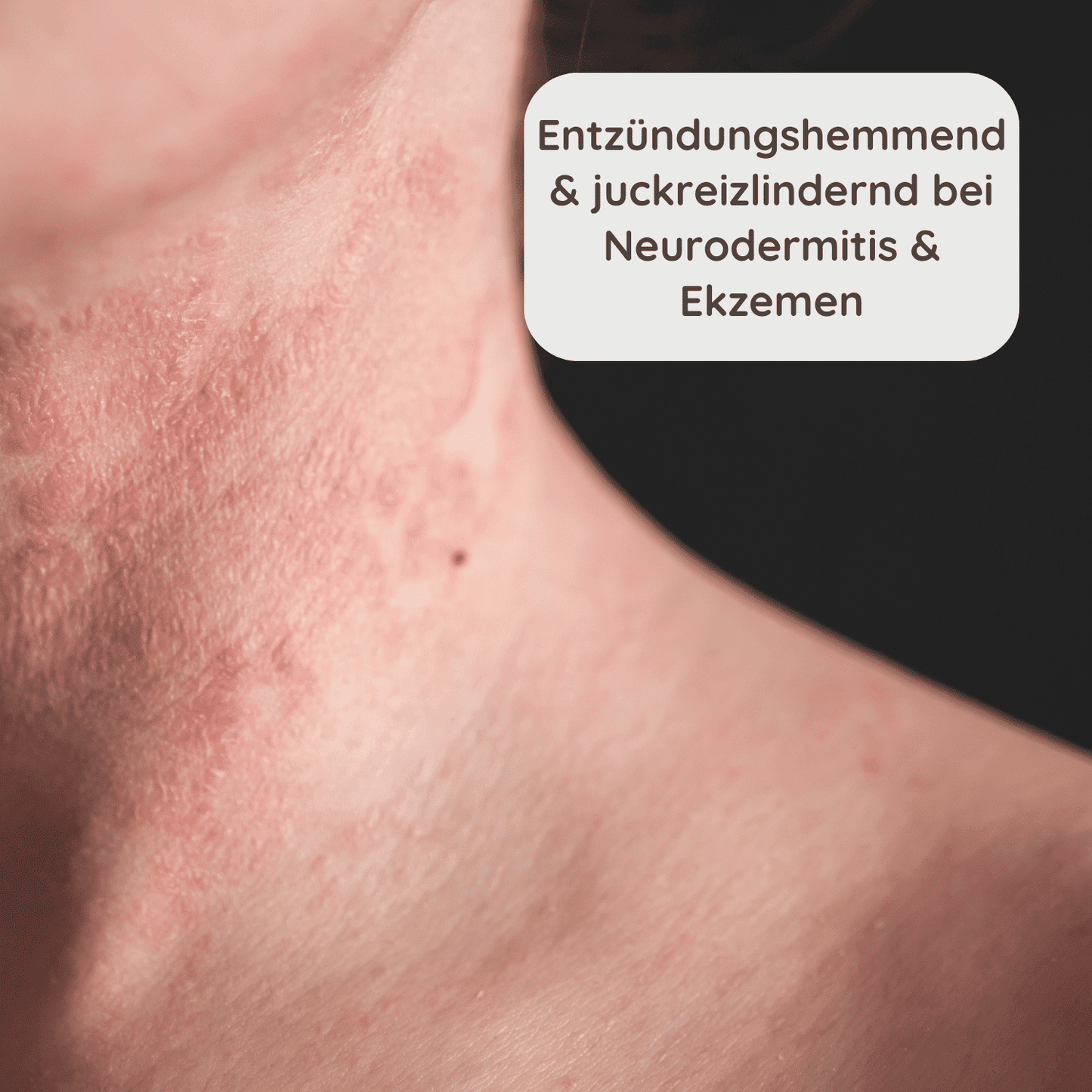 Ein Bild von einem Hals mit Neurodermitis und Ekzemen, das gerötete und gereizte Haut zeigt. Der Text im Bild besagt: “Entzündungshemmend & juckreizlindernd bei Neurodermitis & Ekzemen”.