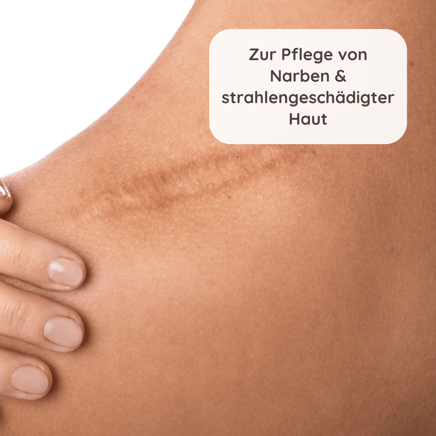 Nahaufnahme einer Narbe an der Schulter einer Person mit heller Hautfarbe und Textfeld zur Hautpflege.