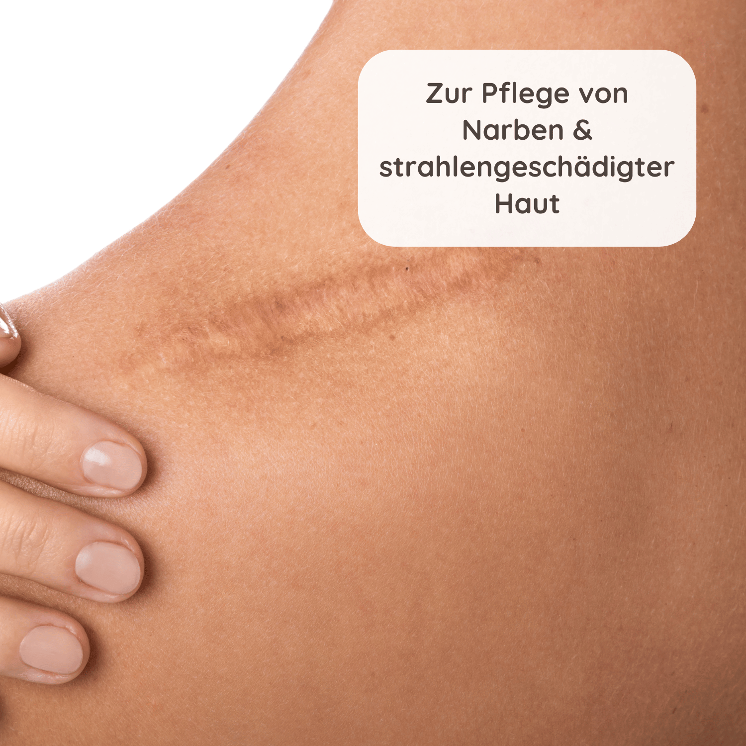 Nahaufnahme einer Narbe an der Schulter einer Person mit heller Hautfarbe und Textfeld zur Hautpflege.
